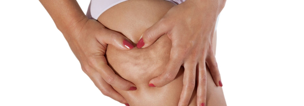cellulite