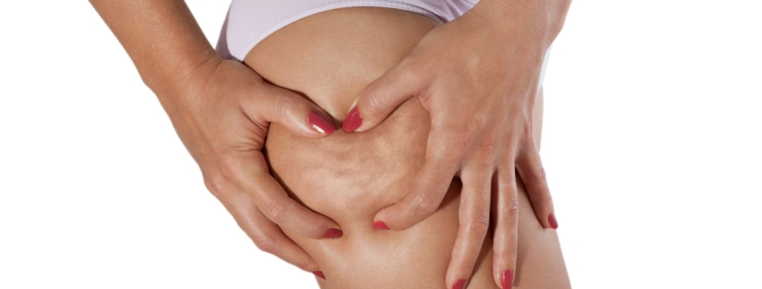 cellulite